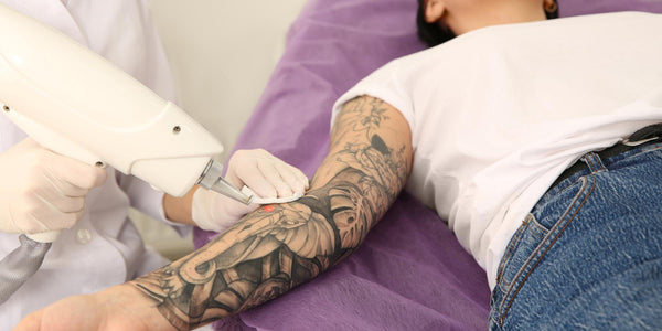 Tätowierungen entfernen: Techniken und Risiken der Tattoo-Entfernung